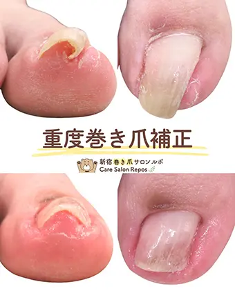 重度巻き爪補正