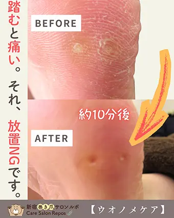 ウオノメケア